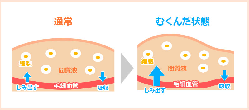 むくみ（浮腫）とは